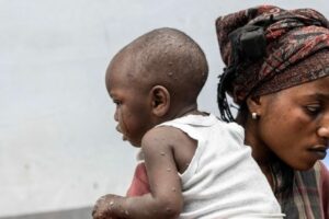Metade dos casos suspeitos de mpox na Guiné Bissau são crianças